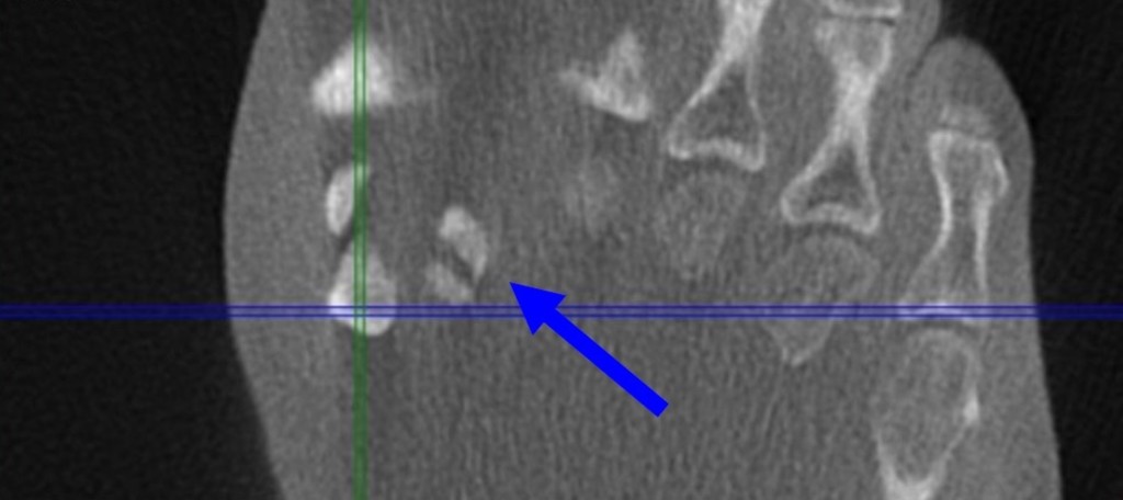 pedCAT double sesamoid fracture
