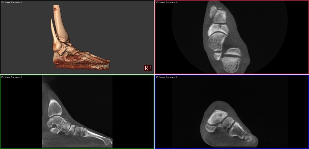 pedCAT Stress Fracture Cross Section