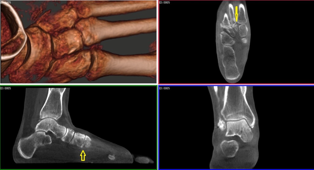 Midfoot dislocation, fracture, pedCAT