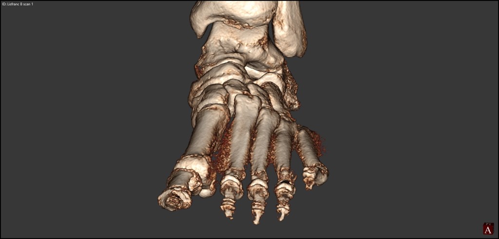 lisfranc AP