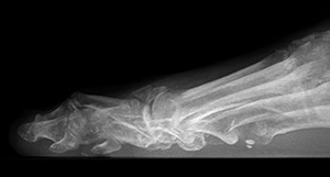 Implant Arthroplasty Candidate X-Ray