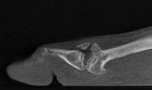 fractured 2nd MT head pedCAT weight bearing CT