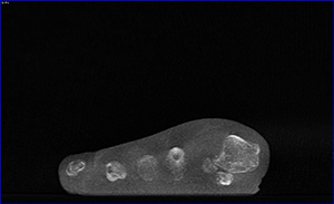 1st MT Bone Spur - Weight Bearing CT