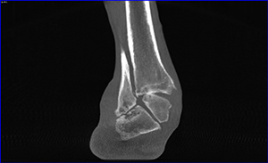 Calcaneal-fibular impingement and arthritis - Weight Bearing CT