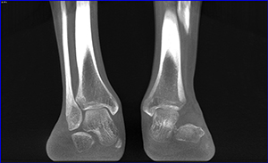 Impingement - weight bearing CT