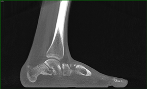Vertical Talus - Weight Bearing CT