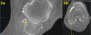 Figure 5a: Sagittal SCTa image demonstrating a small tear of the tibial surface of the post. horn of the medial meniscus Figure 5b: Axial image depicting location of sagittal slice in Figure 5a 