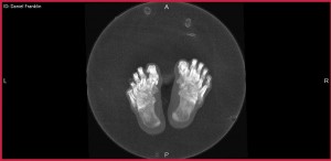 pedCAT weight bearing CT ballet 