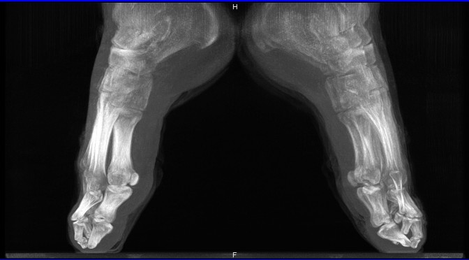 pedCAT weight bearing CT scan ballet