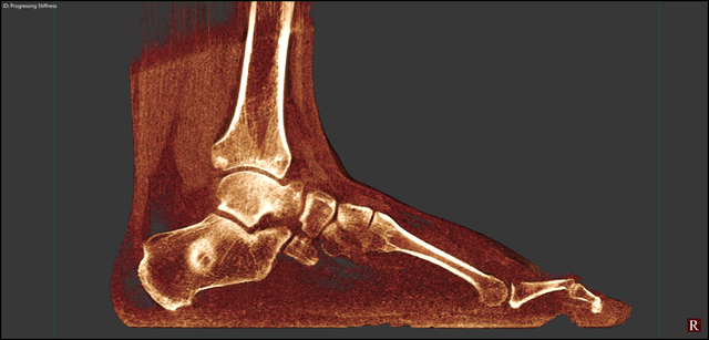 This 3D rendering, as displayed in CubeVue, CurveBeam's custom visualization software, shows a lesion in the calcaneus.