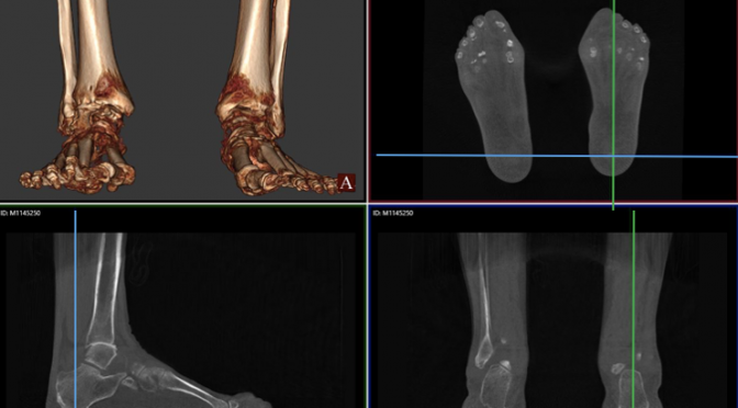 Calcaneus contact point