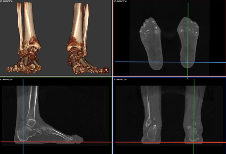Comparison of Three Hindfoot Alignment Measurements: Radiographic ...