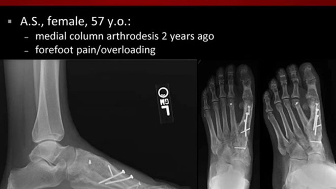 Literature-Review-and-Case-Studies-from-CurveBeams-Weight-Bearing-CT-of-the-Foot-and-Ankle-Webinar