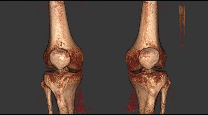 knee 3d bilateral