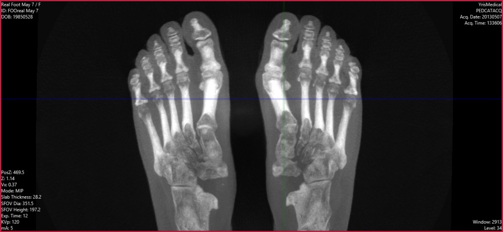 Hallux Valgus