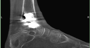 Before MAR Lateral