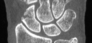 The CurveBeam InReach provides 0.2mm high resolution slices of the distal limbs.