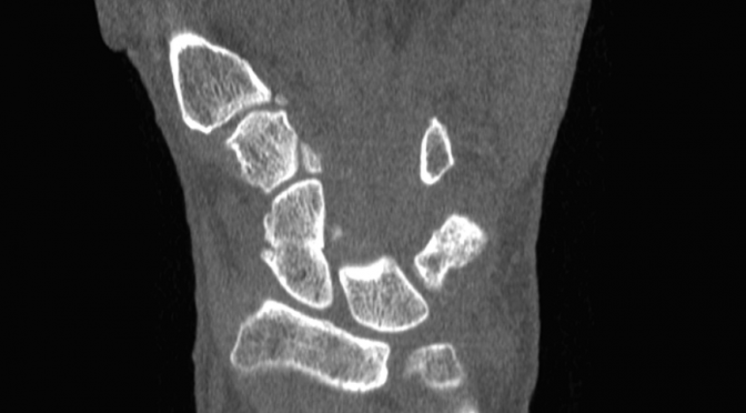 CT Confirms Scaphoid Fracture Union Quicker than X-Ray